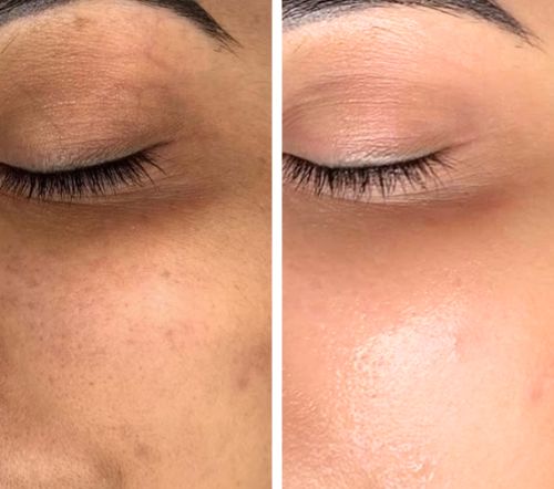 Before and after using VitalGluta pigment reducer cream, showcasing skin improvement and pigment reduction.