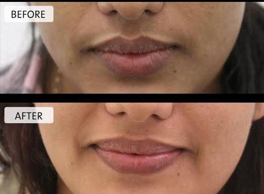 How to Remove Dark Spots and Pigmentation Naturally