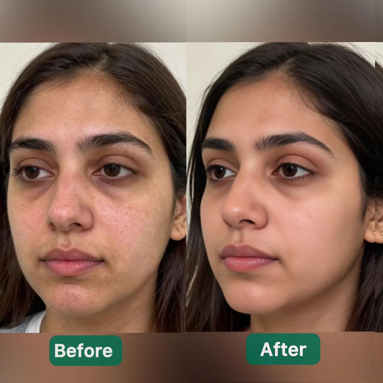 Before and after comparison of a woman's face with  visible results after using   VitalGluta pigment reducer cream  changes.