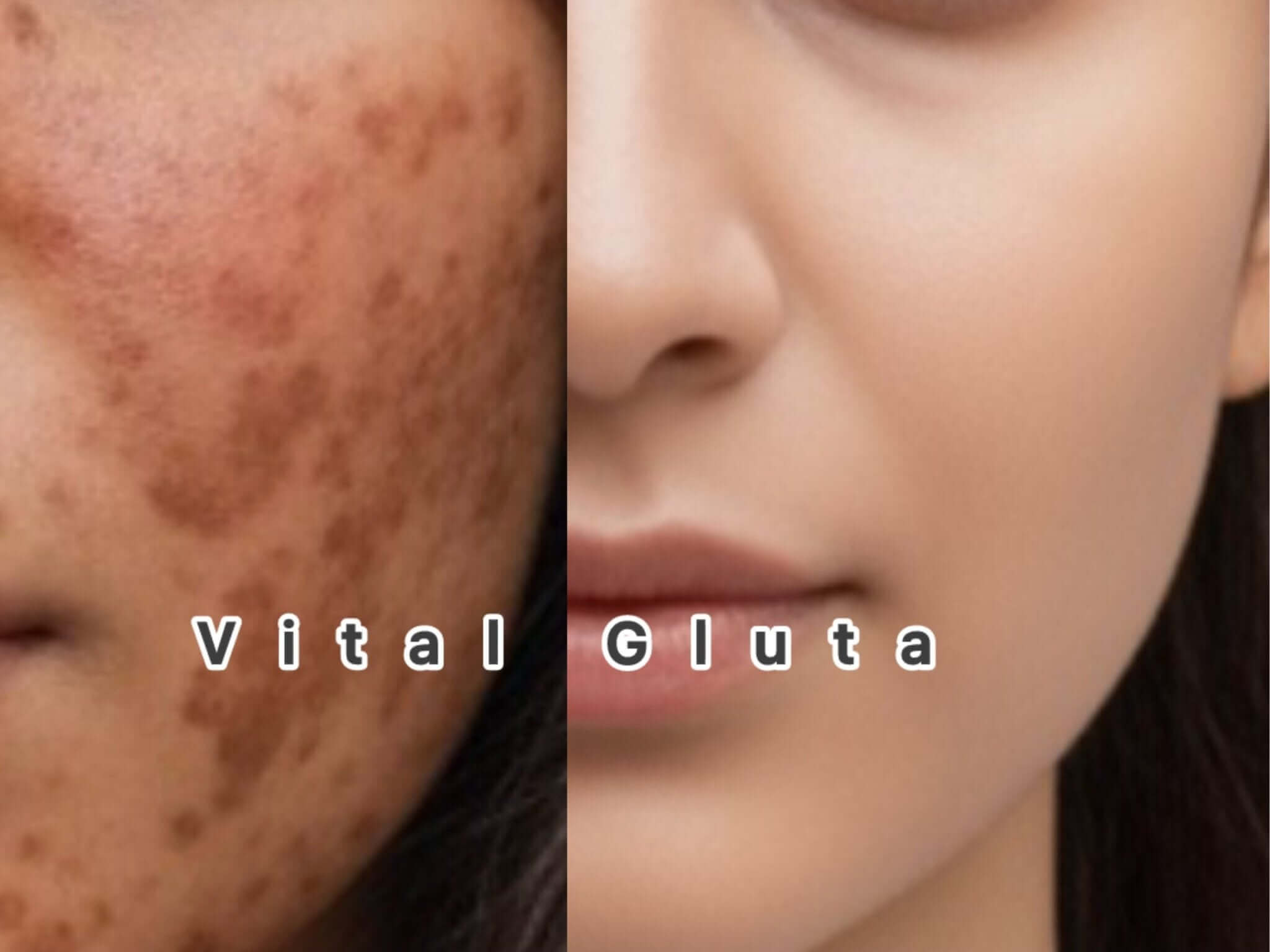 Before and after using VitalGluta pigment reducer cream, showcasing skin improvement and pigment reduction.