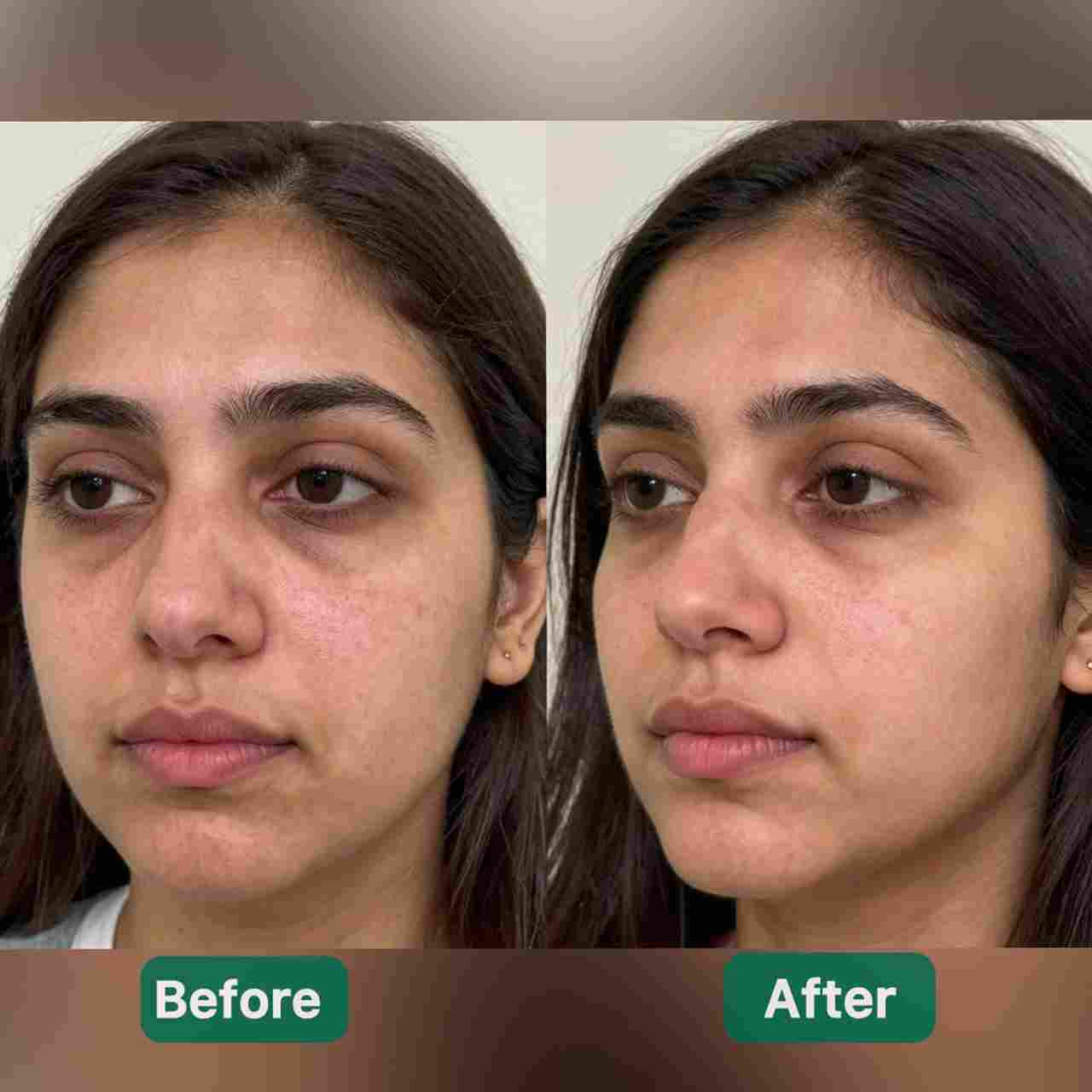 4 VitalGluta Bundle Anti - Pigmentation - Vital Gluta