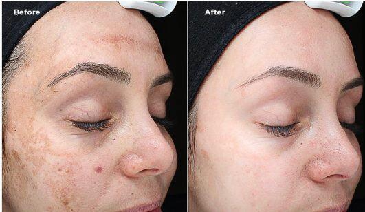 Before and after comparison of a woman's face with acne treatment.